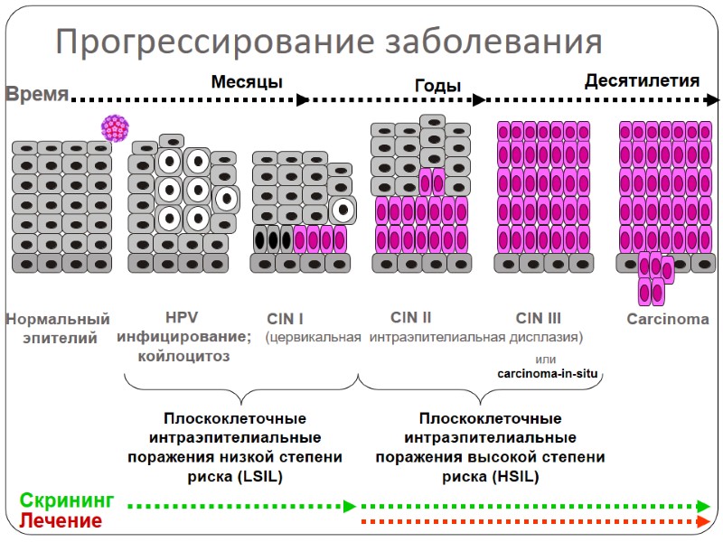 Прогрессирование заболевания Плоскоклеточные интраэпителиальные поражения низкой степени риска (LSIL) Плоскоклеточные интраэпителиальные поражения высокой степени
